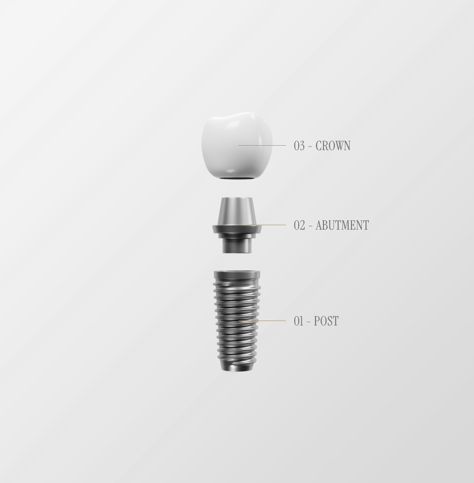 Dental implant diagram showing post, abutment, and crown components