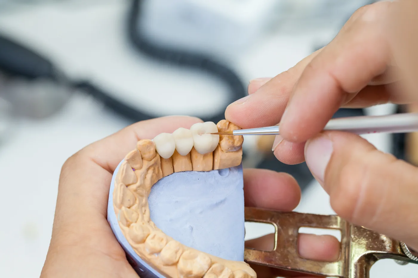 Dental crowns and bridges restoration